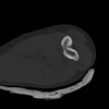 SPORK, NICO - 22.03.1976 - 02.08.2022 - CT obere Extremität - 18:02:23